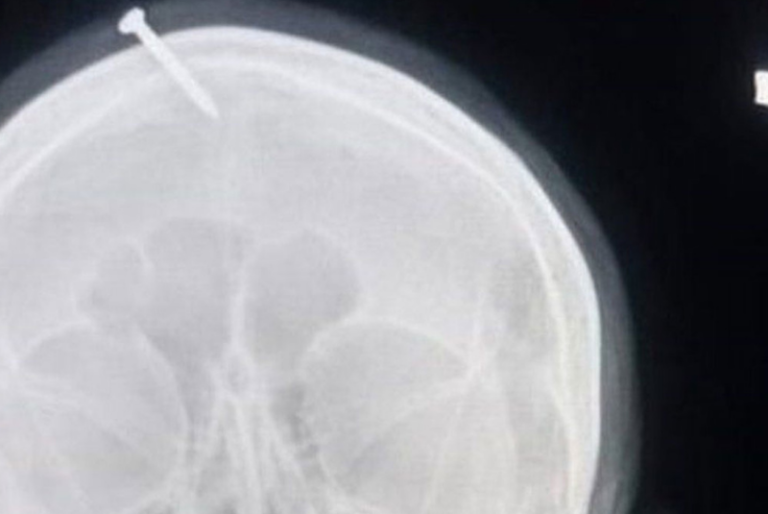 Curandero incrusta clavo en cabeza de embarazada para dar a luz a un niño