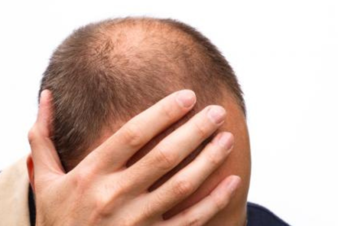 alopecia