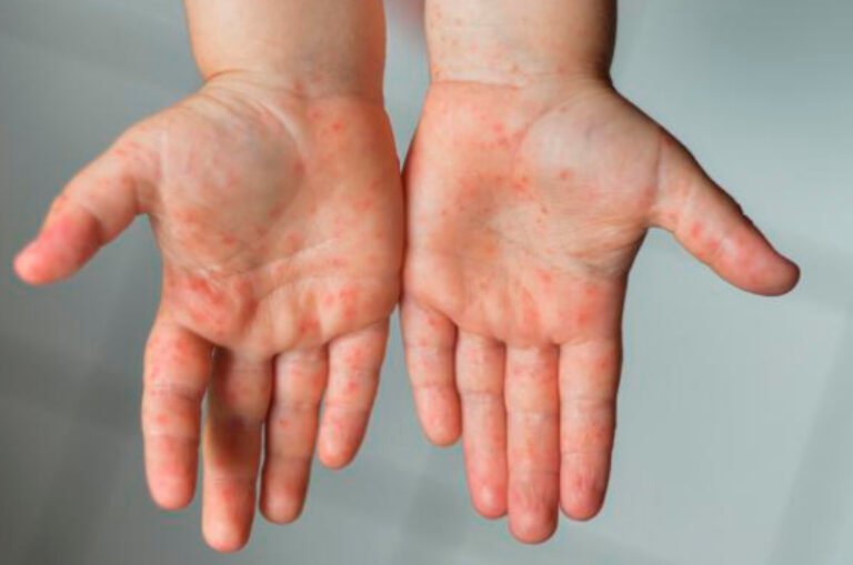 Nuevo León confirma primer caso de Viruela del Mono